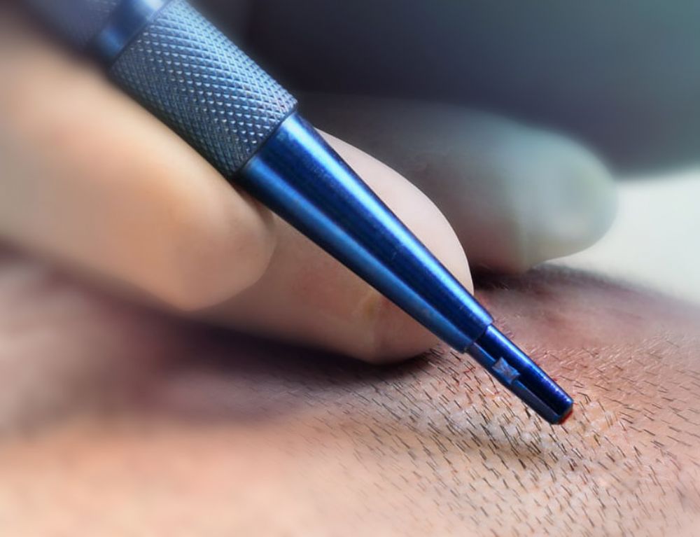 SAFİR FUE Saç Ekimi