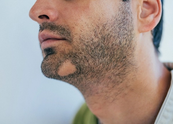 Sakal Ekimi Neden Yapılır? Sakallar Neden Dökülür?