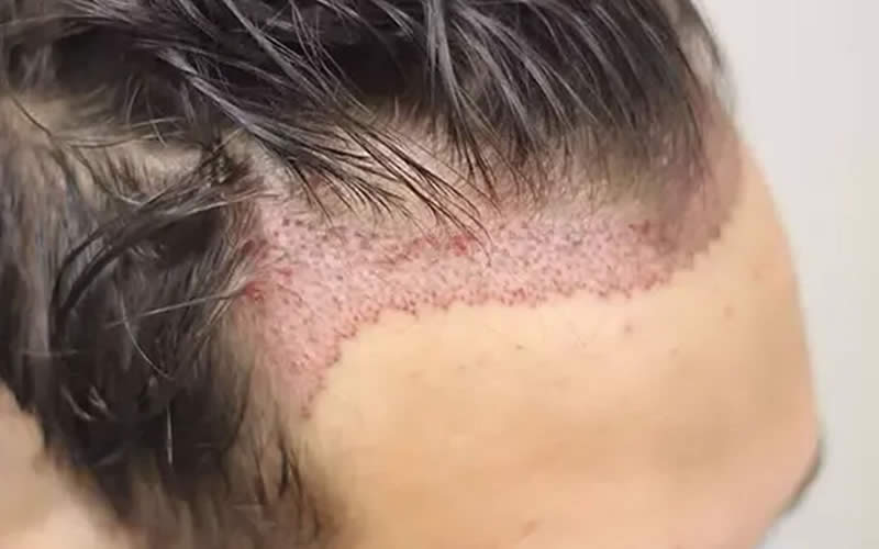 Tıraşsız Saç Ekimi Aşamaları Nelerdir?