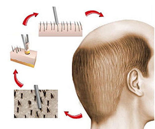  Mega graft hair transplant center