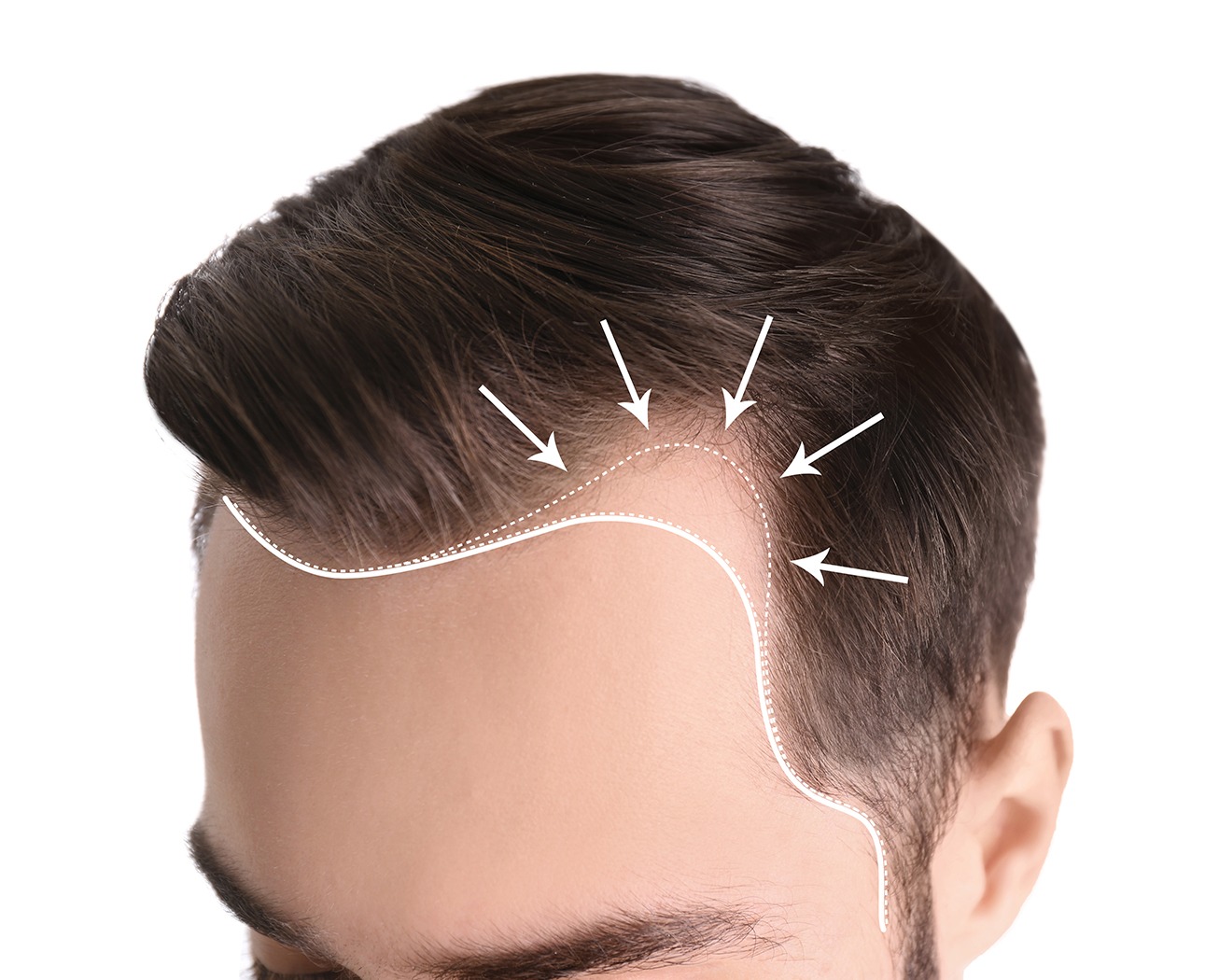  Mega graft hair transplant center